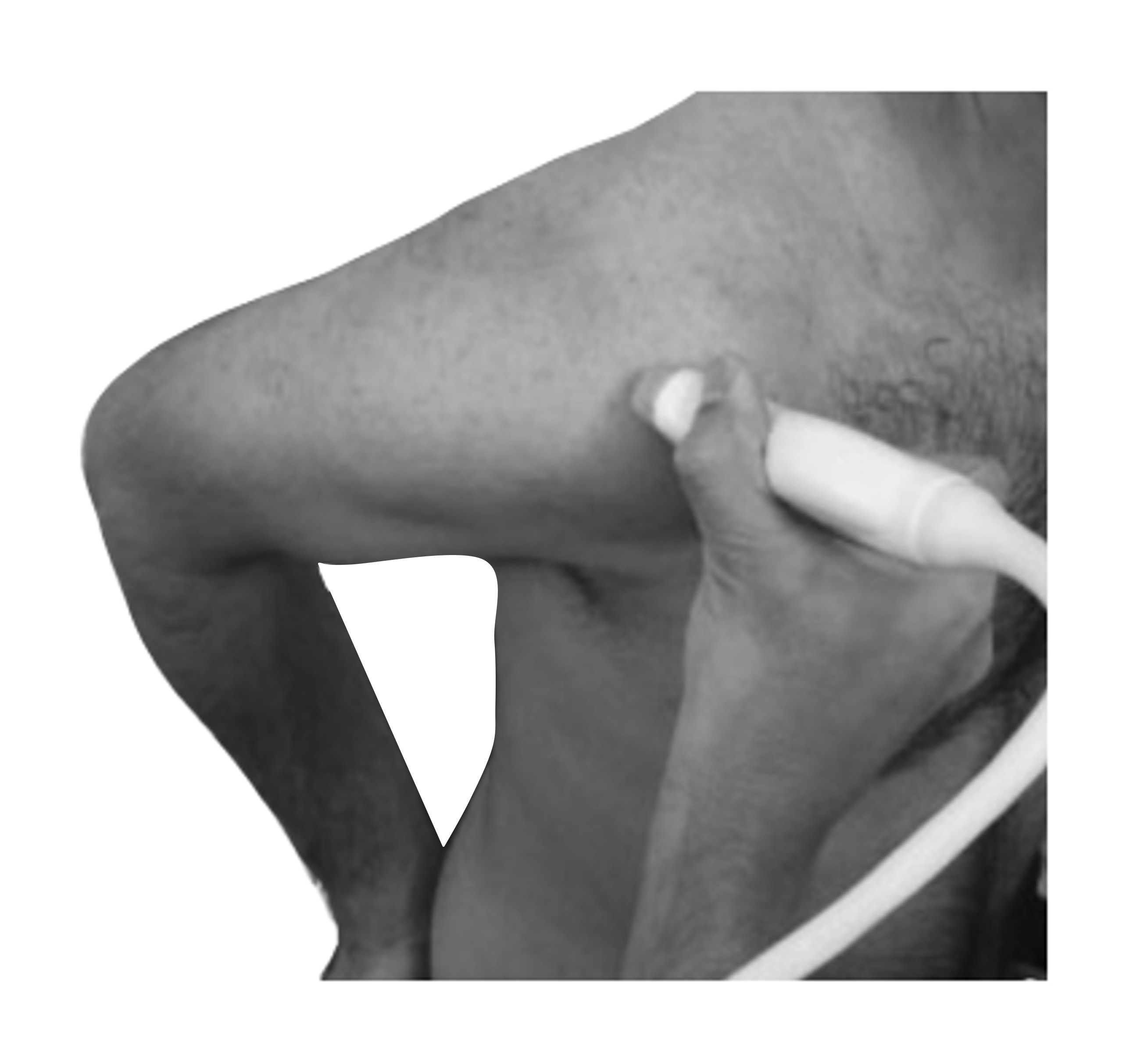 Patient seated with affected arm placed behind back in the modified Crass position, with ultrasound probe applied over the antero-superior shoulder.