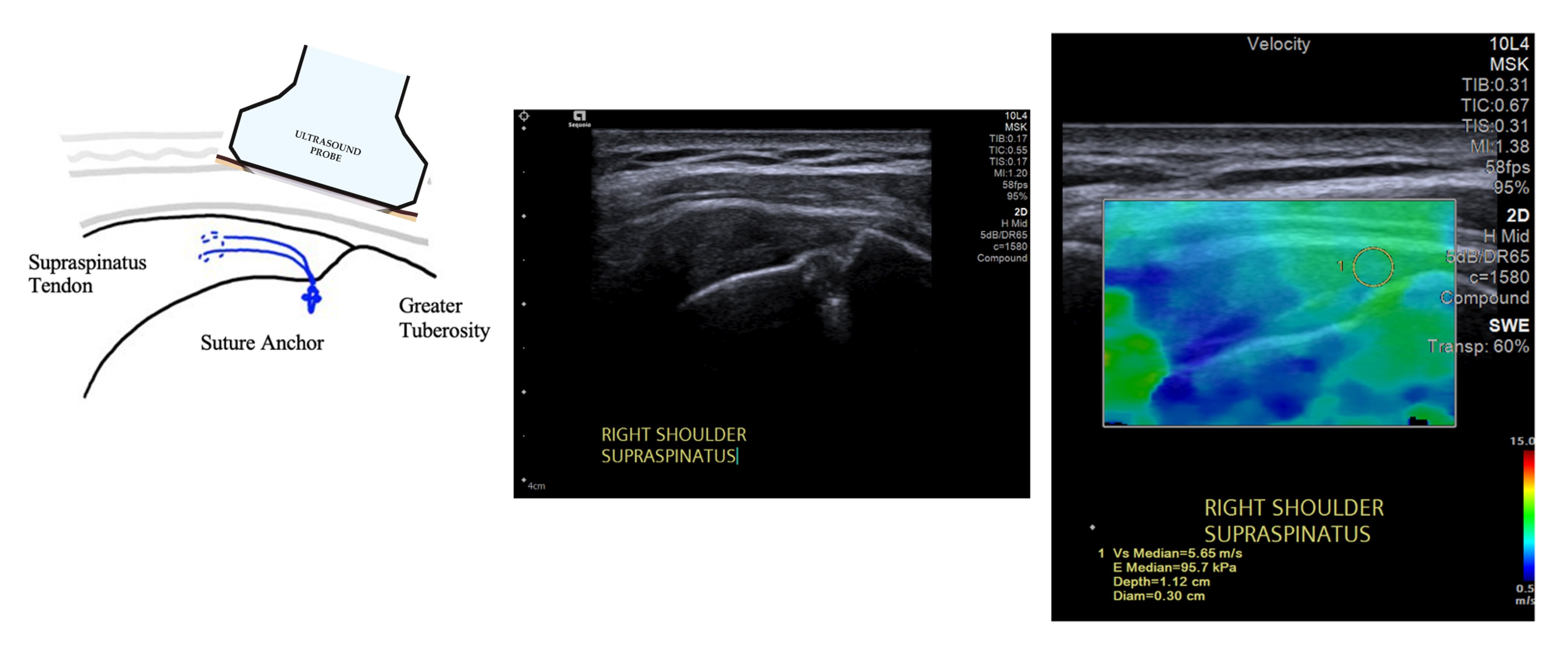 Three-panel figure: anatomical schematic showing probe over supraspinatus with suture anchor in greater tuberosity; corresponding B-mode ultrasound image of the right supraspinatus tendon; and shear-wave elastography overlay with a circular ROI giving a median velocity of 5.65 m/s.